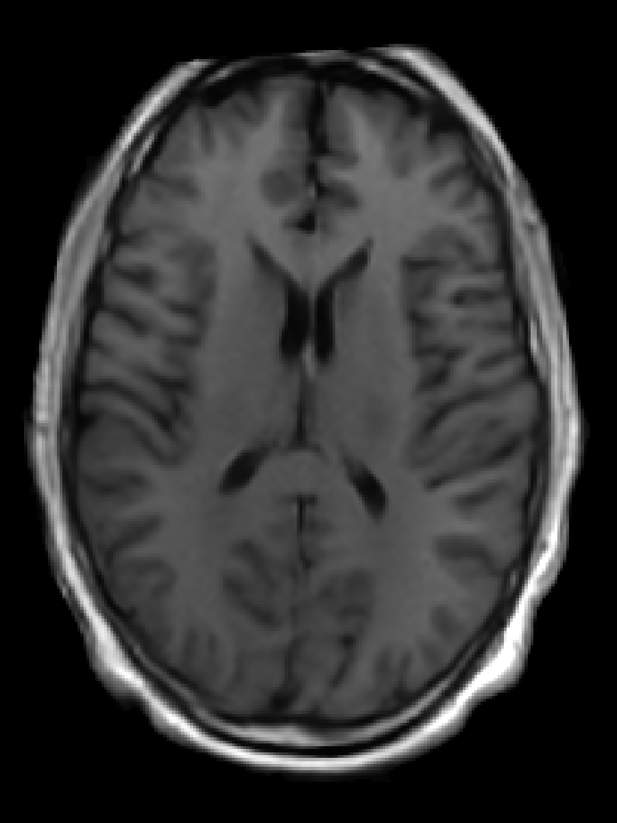 T1 (Gray/White)