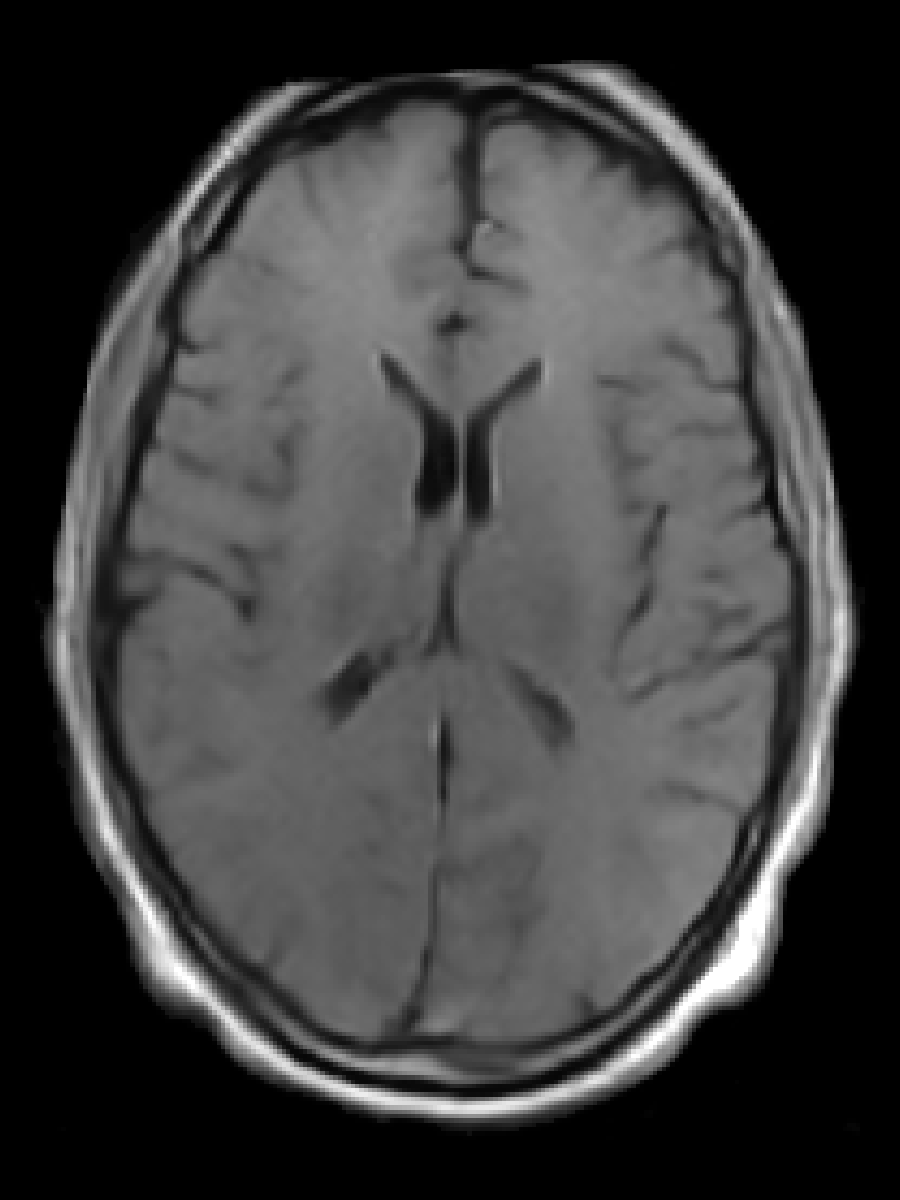 T1 (Standard)