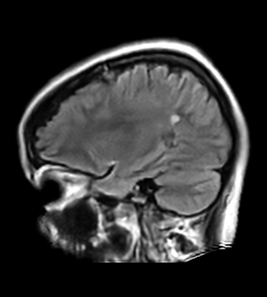 Multiple Sclerosis