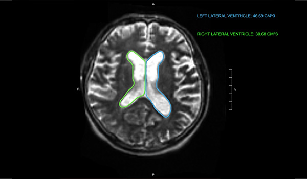 BrainInsight<sup><sub>™</sub></sup>—automated AI tools.