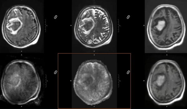 Point-of-Care MR Imaging for the Neurocritical Patient - A Case-Based Review