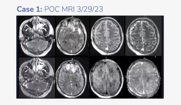 Rapid Rounds: Ultra-Low-Field MRI™ in the ICU